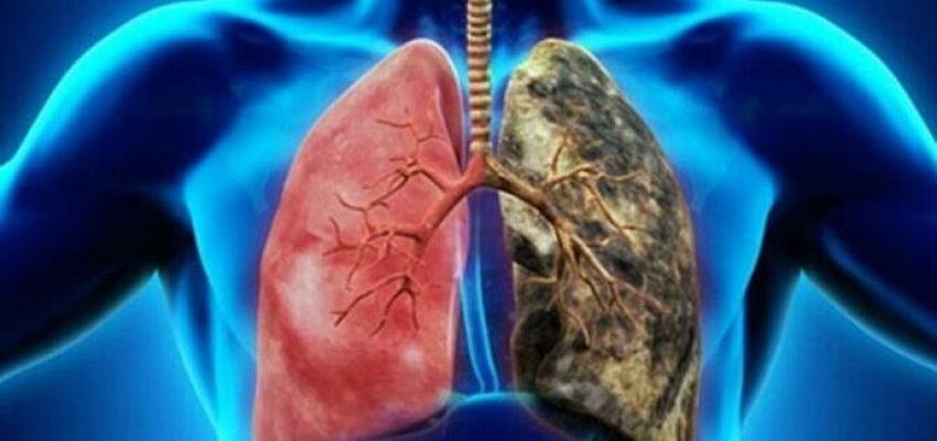 Akciğer Kanseri ve İnsanlık savaş halinde!