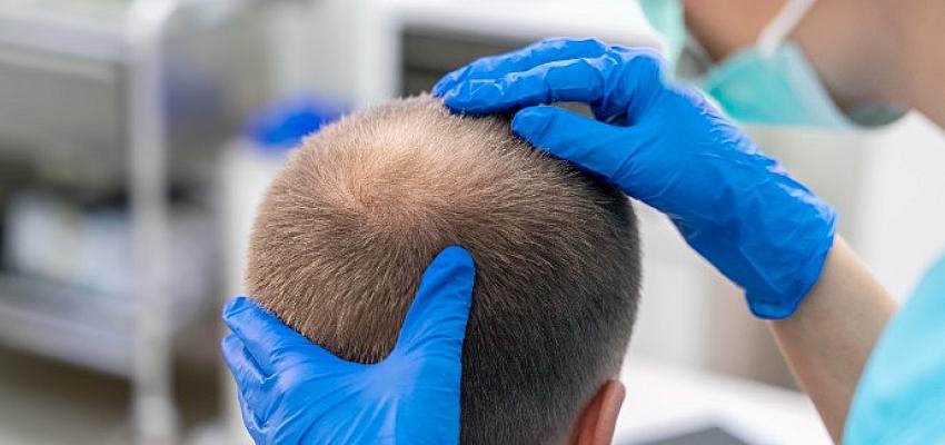 Medikal Estetik Uygulamaları Saç Problemlerini Ortadan Kaldırıyor